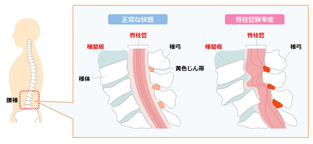 腰痛メカニズム